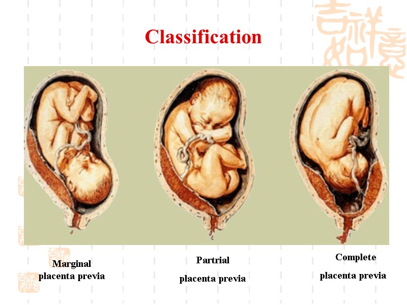 Classification Complete  placenta previa Partrial  placenta previa Marginal placenta previa